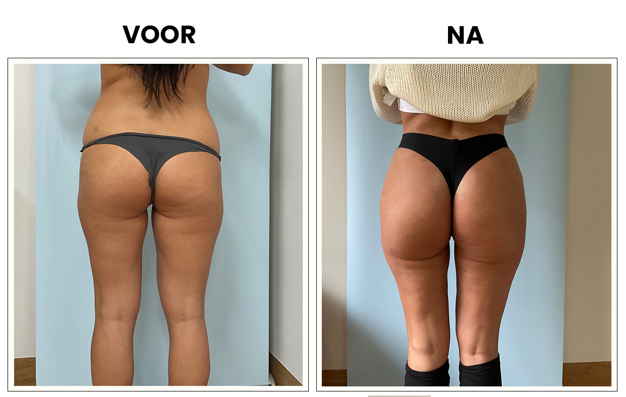 lipofilling billen lipofilling billen